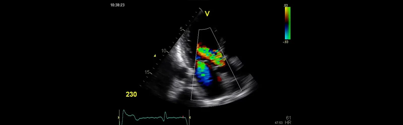 What is the Meaning of Colors in Color Doppler Ultrasound?